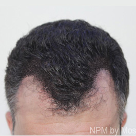mikropigmentacja a łysienie na zakolach głowy